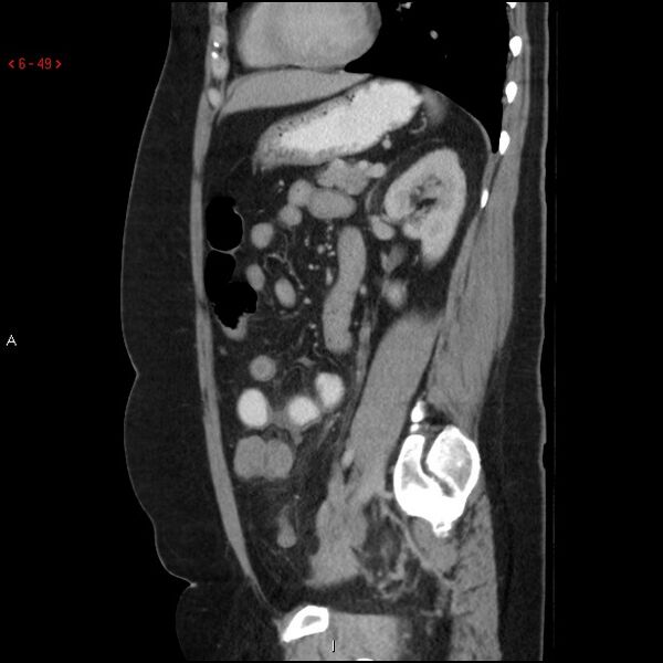 File:Appendicitis with microperforation- promontoric type (Radiopaedia 27268-27442 A 34).jpg