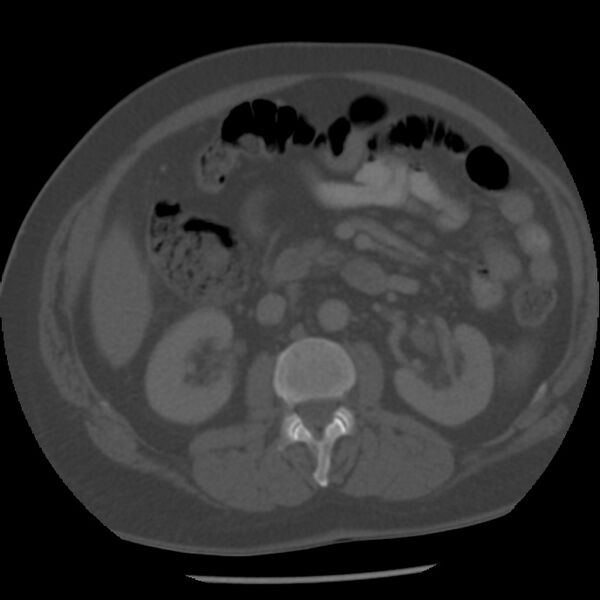 File:Appendicitis with perforation (Radiopaedia 35790-37342 Axial bone window 22).jpg