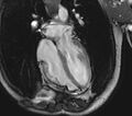 Arrhythmogenic right ventricular cardiomyopathy (Radiopaedia 39806-42237 D 57).jpg