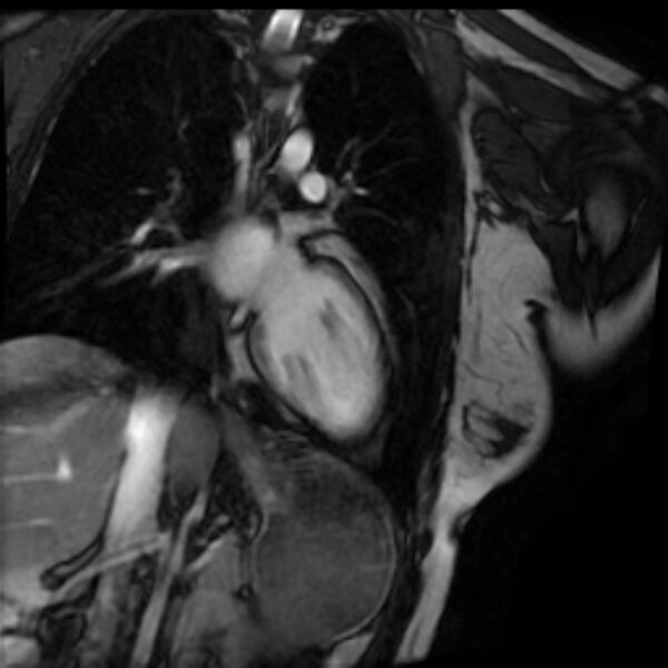 File:Arrhythmogenic right ventricular cardiomyopathy (Radiopaedia 87505-103850 2ch (LV) Cine SSFP 57).jpg