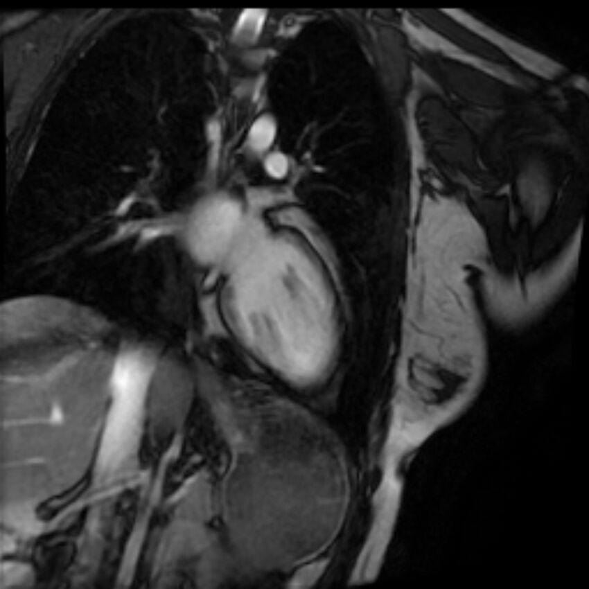 Arrhythmogenic right ventricular cardiomyopathy (Radiopaedia 87505-103850 2ch (LV) Cine SSFP 57).jpg