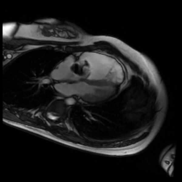 File:Arrhythmogenic right ventricular cardiomyopathy (Radiopaedia 87505-103850 4ch Cine SSFP 67).jpg