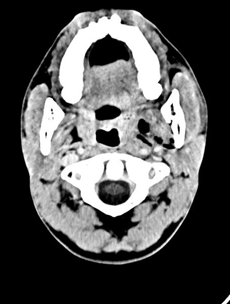 File:Arrow injury to the face (Radiopaedia 73267-84011 Axial C+ delayed 26).jpg