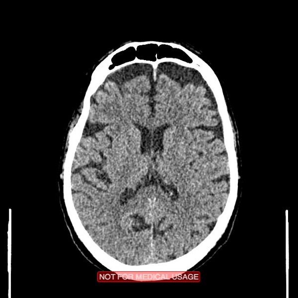 File:Artery of Percheron infarction (Radiopaedia 28679-28967 Axial non-contrast 68).jpg