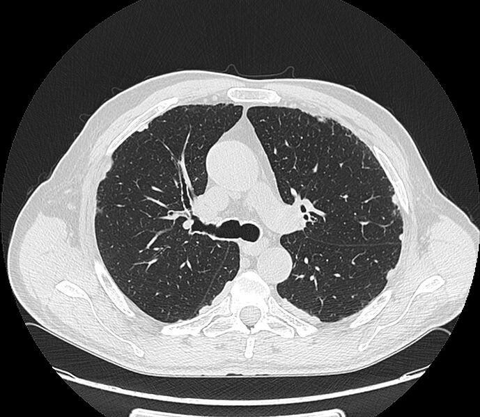 File:Asbestos pleural placques (Radiopaedia 57905-64872 Axial lung window 98).jpg