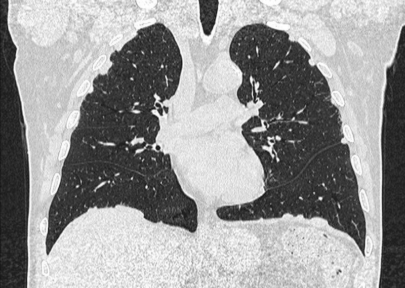 File:Asbestos pleural placques (Radiopaedia 57905-64872 Coronal lung window 133).jpg