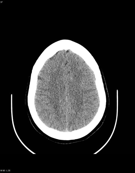 File:Astroblastoma (Radiopaedia 39792-42216 Axial non-contrast 36).jpg