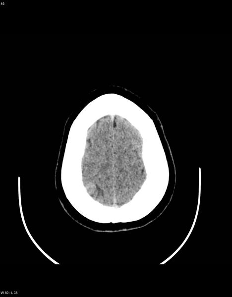 File:Astroblastoma (Radiopaedia 39792-42216 Axial non-contrast 44).jpg