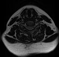 Astrocytoma - spinal cord (Radiopaedia 69769-79758 Axial T2 14).jpg