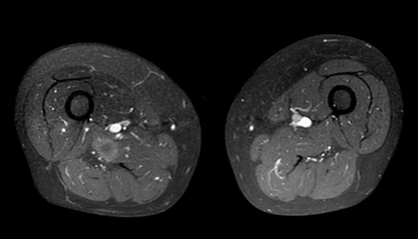 Atypical lipomatous tumor - thigh (Radiopaedia 68975-78734 Axial T1 C+ fat sat 46).jpg