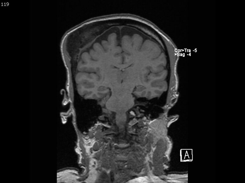 File:Atypical meningioma - intraosseous (Radiopaedia 64915-74572 Coronal T1 119).jpg