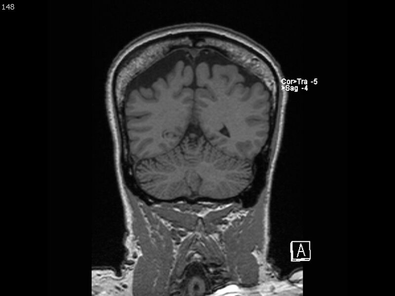 File:Atypical meningioma - intraosseous (Radiopaedia 64915-74572 Coronal T1 148).jpg