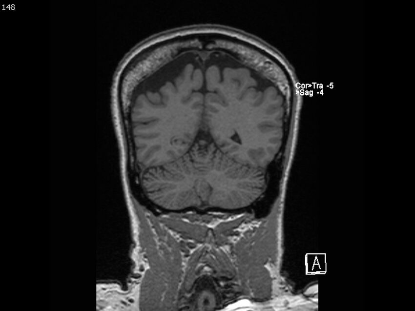 Atypical meningioma - intraosseous (Radiopaedia 64915-74572 Coronal T1 148).jpg