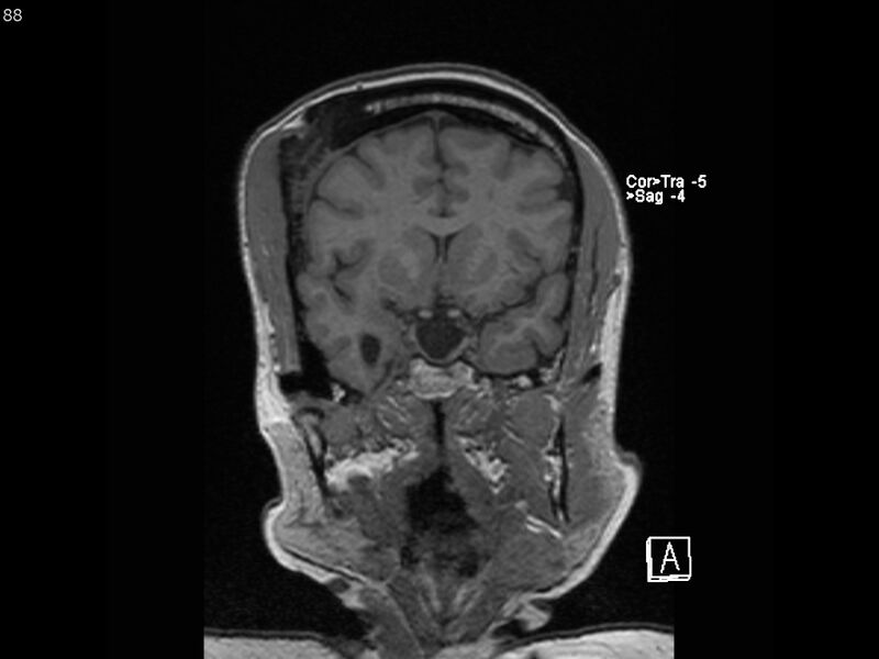 File:Atypical meningioma - intraosseous (Radiopaedia 64915-74572 Coronal T1 88).jpg