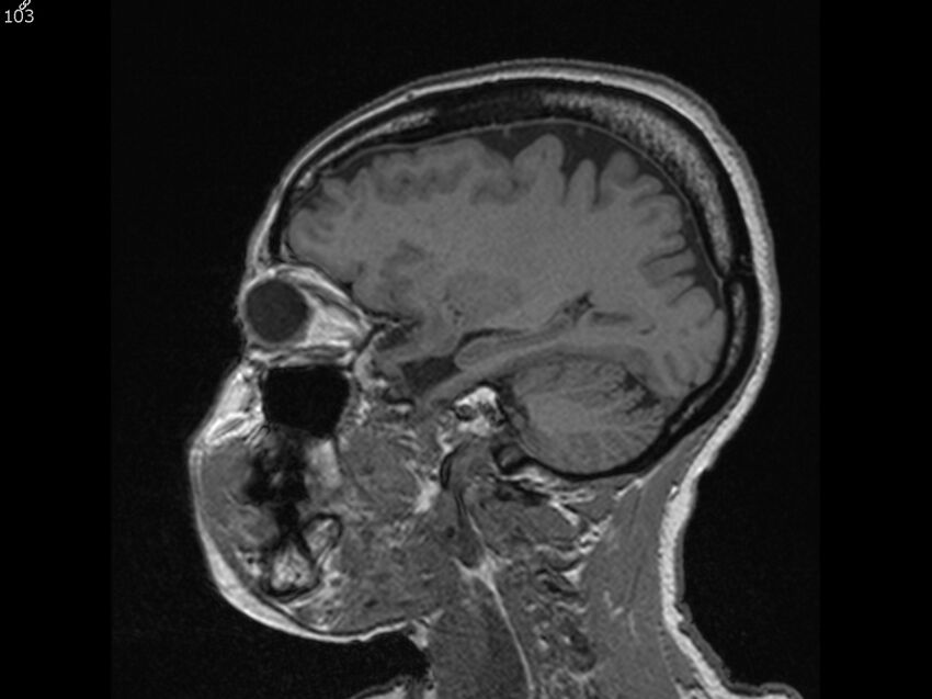 Atypical meningioma - intraosseous (Radiopaedia 64915-74572 Sagittal T1 103).jpg