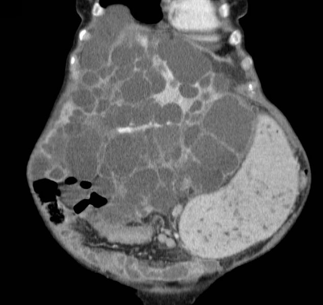 File:Autosomal dominant polycystic kidney disease (Radiopaedia 16777-16490 B 8).jpg