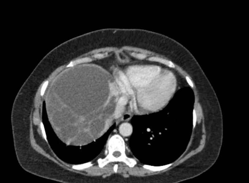 File:Autosomal dominant polycystic kidney disease (Radiopaedia 57124-64017 A 17).jpg