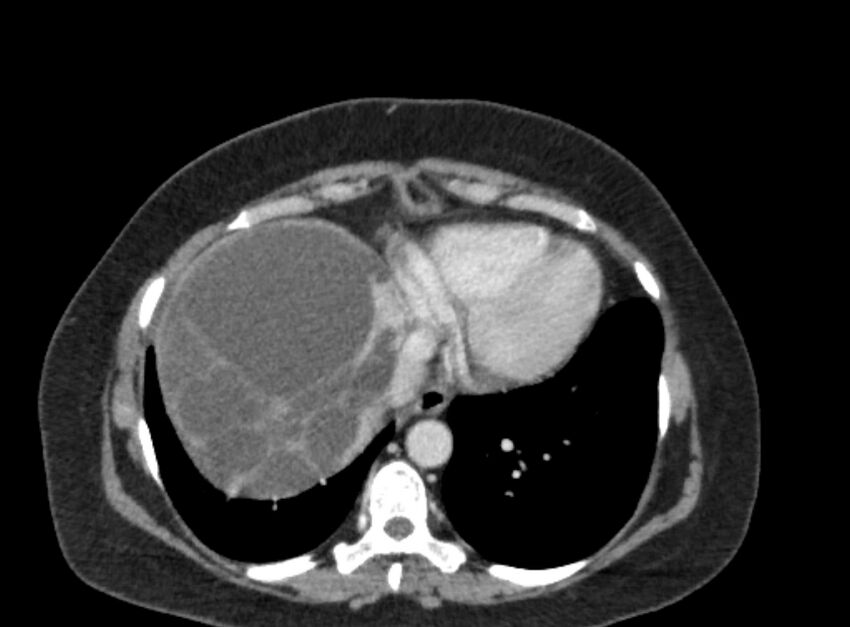 Autosomal dominant polycystic kidney disease (Radiopaedia 57124-64017 A 17).jpg