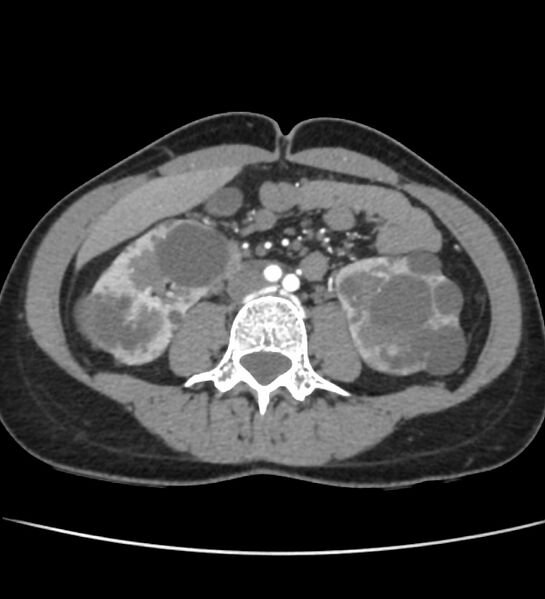 File:Autosomal dominant polycystic kidney disease - early onset (Radiopaedia 40734-43387 B 40).jpg