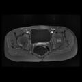 Avascular necrosis of the hip (Radiopaedia 29563-30067 Axial T1 C+ fat sat 5).jpg