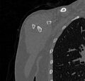 Avulsion fracture - greater tuberosity of humerus (Radiopaedia 71216-81514 Coronal bone window 4).jpg