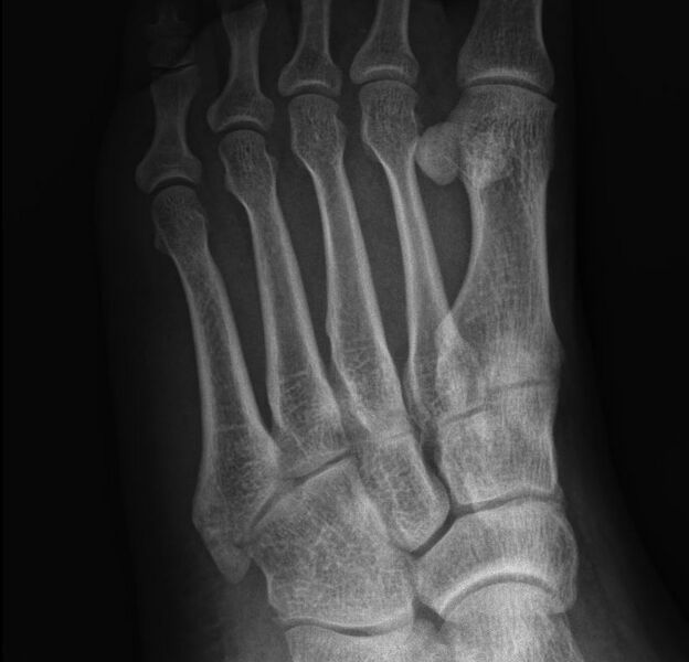 File:Avulsion fracture of the 5th metatarsal styloid - pseudo-Jones fracture (Radiopaedia 64009-72761 Oblique - zoomed 1).JPG
