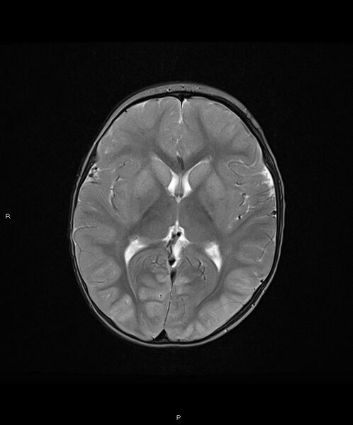 File:Basal ganglia and parenchymal ischemia (Radiopaedia 45818-50084 Axial T2 11).jpg