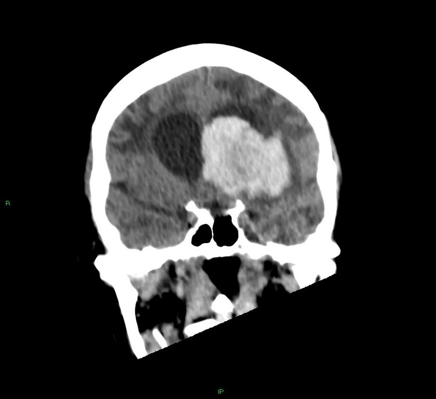 Basal ganglia hemorrhage (Radiopaedia 58766-65988 Coronal non-contrast 43).jpg
