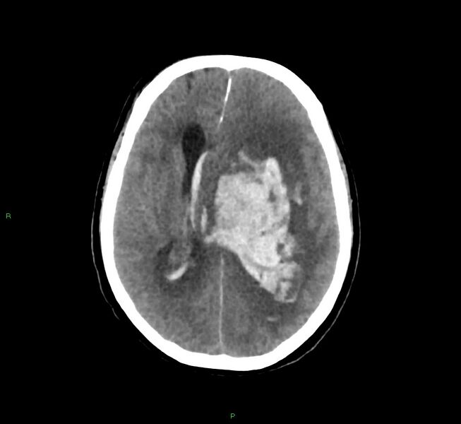 File:Basal ganglia hemorrhage (Radiopaedia 58775-66008 Axial non-contrast 29).jpg