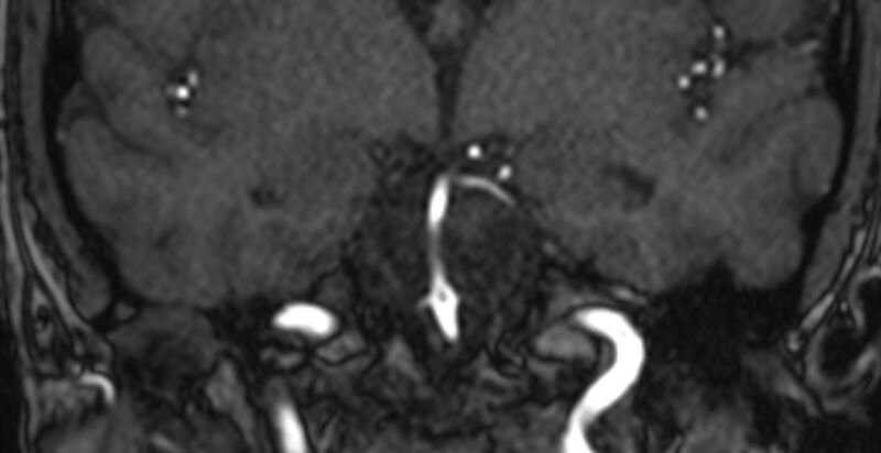 File:Basilar artery fenestration (Radiopaedia 74537-85455 Coronal MRA TOF 39).jpg