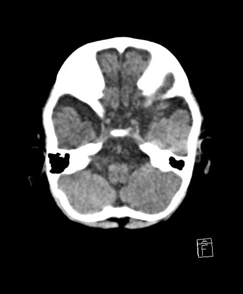 File:Benign enlargement of subarachnoid spaces in infancy (BESS) (Radiopaedia 87459-103795 Axial non-contrast 69).jpg