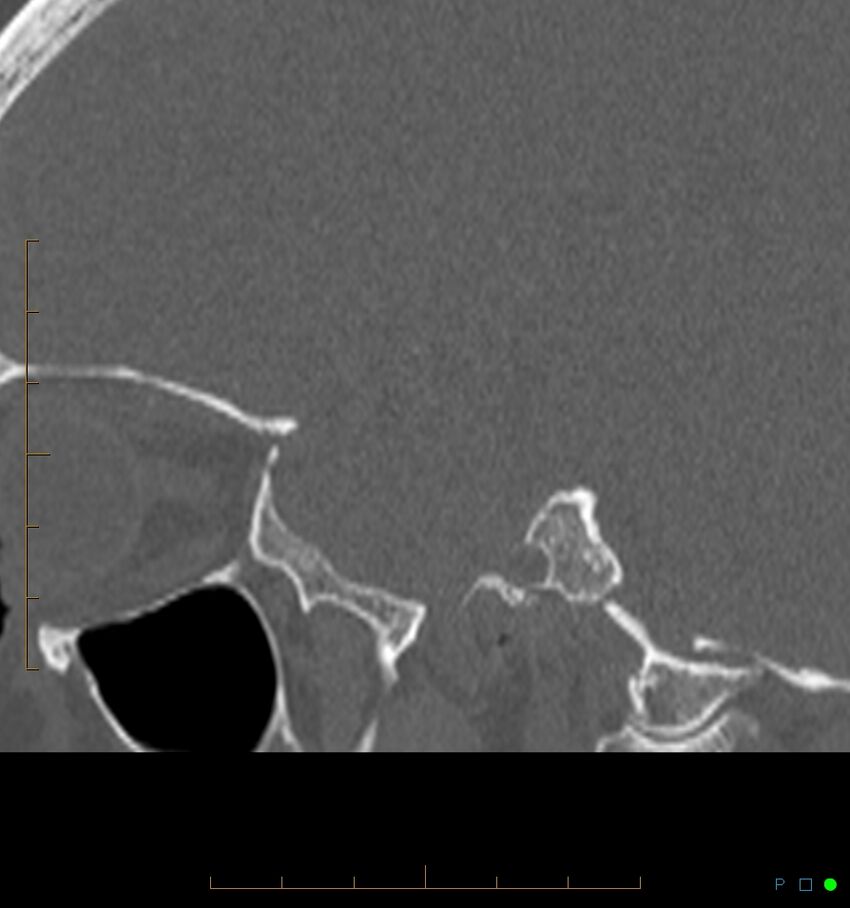 Benign notochordal cell tumor (probable) (Radiopaedia 65475-74546 Sagittal bone window 52).jpg