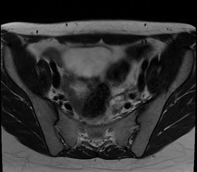 File:Bicornuate uterus (Radiopaedia 71214-81511 Axial T2 24).jpg