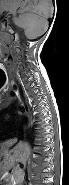 File:Bilateral Sprengel deformity with Klippel-Feil syndrome (Radiopaedia 66395-75650 Sagittal T1 4).jpg