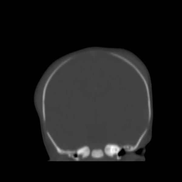 File:Bilateral cephalohematomas and subdural hematomas (Radiopaedia 26778-26929 Coronal bone window 11).jpg