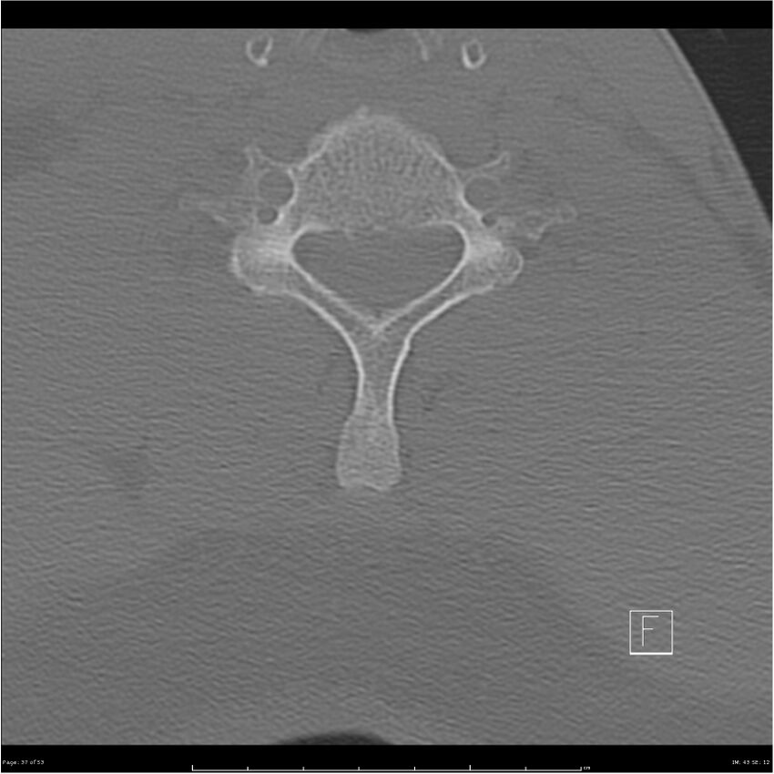 Bilateral cervical ribs (Radiopaedia 25868-26017 Axial bone window 37).jpg
