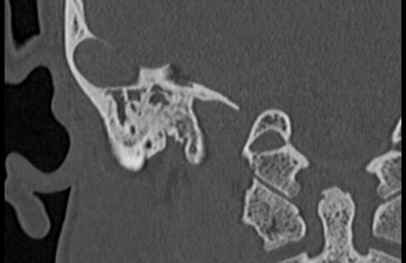 File:Bilateral cholesteatoma (Radiopaedia 54898-61172 Coronal bone window 66).jpg