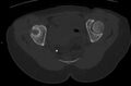 Bilateral mature cystic ovarian teratoma (Radiopaedia 88821-105592 Axial bone window 35).jpg