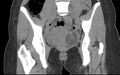 Bilateral mature cystic ovarian teratoma (Radiopaedia 88821-105592 Coronal non-contrast 16).jpg