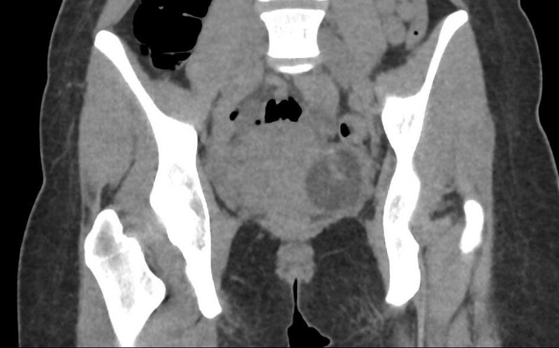 File:Bilateral mature cystic ovarian teratoma (Radiopaedia 88821-105592 Coronal non-contrast 16).jpg