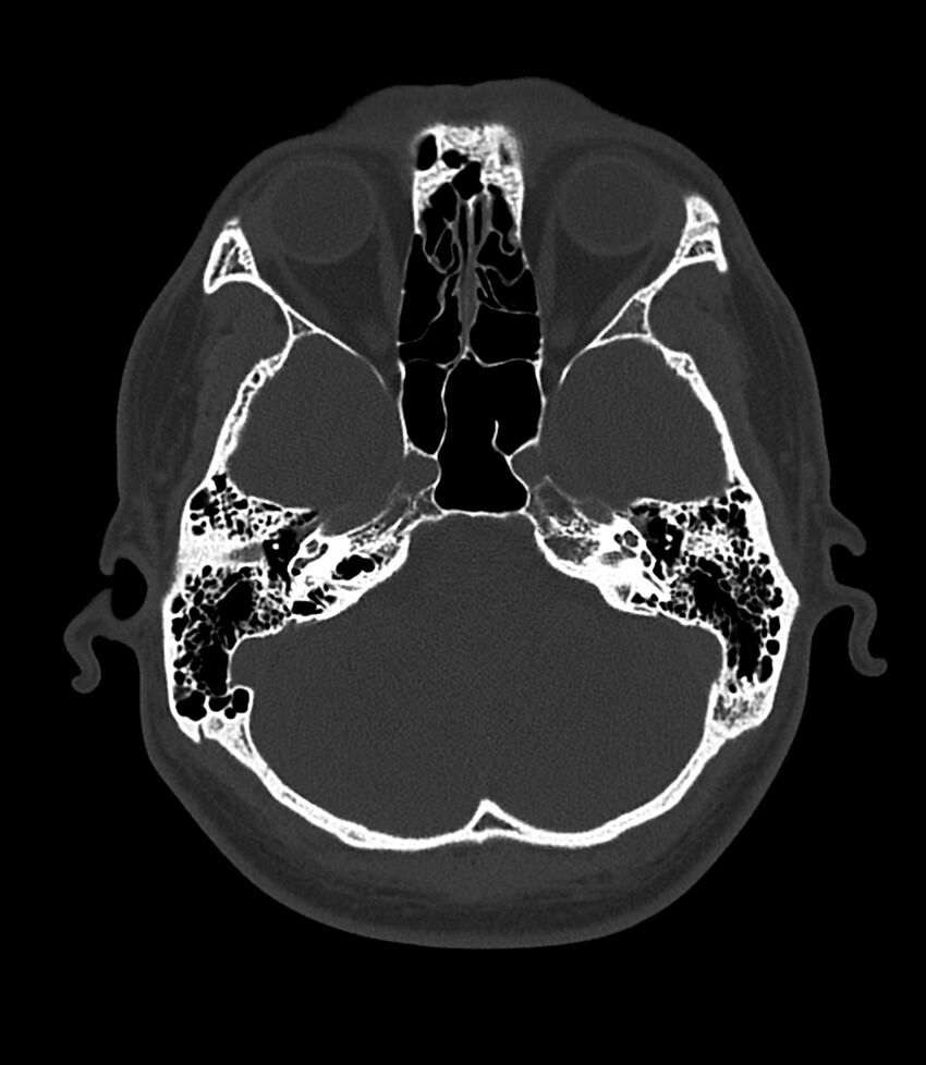 Bilateral medial canal fibrosis (Radiopaedia 85598-101344 Axial bone window 40).jpg