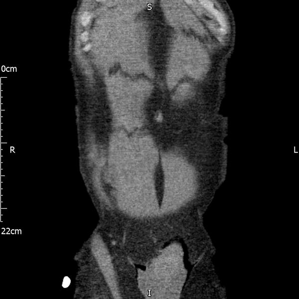 File:Bilateral medullary nephrocalcinosis with ureteric calculi (Radiopaedia 71269-81569 Coronal non-contrast 10).jpg