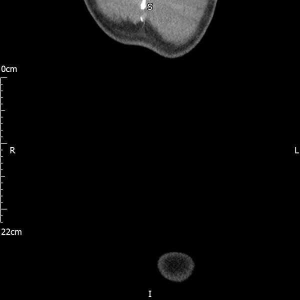 File:Bilateral medullary nephrocalcinosis with ureteric calculi (Radiopaedia 71269-81569 Coronal non-contrast 80).jpg