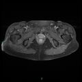 Bilateral ovarian fibroma (Radiopaedia 44568-48293 Axial T1 C+ fat sat 26).jpg
