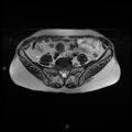 Bilateral ovarian fibroma (Radiopaedia 44568-48293 Axial T2 3).jpg