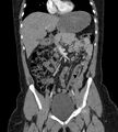 Bilateral ovarian mature cystic teratomas (Radiopaedia 79373-92457 B 22).jpg