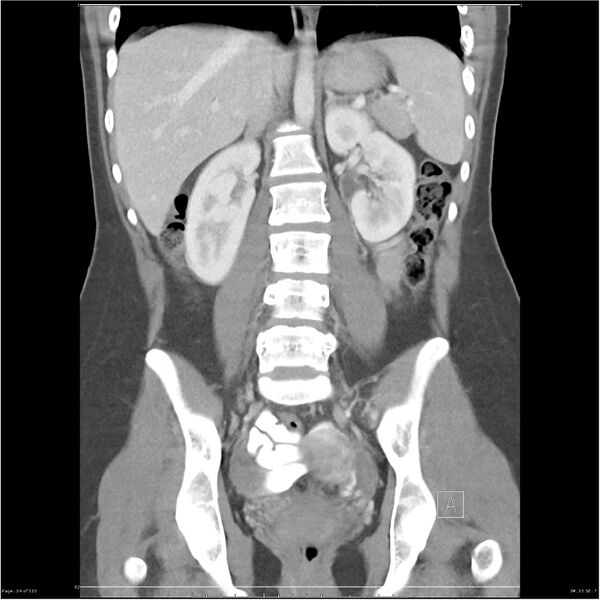 File:Bilateral ureteritis and cystitis (Radiopaedia 25340-25594 B 24).jpg