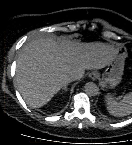 File:Bile leak from accessory duct(s) of Luschka post cholecystectomy (Radiopaedia 40736-43389 A 6).jpg