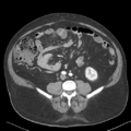 Bladder papillary urothelial carcinoma (Radiopaedia 48119-52951 A 31).png