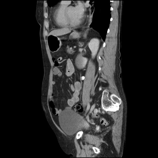 File:Bladder tumor detected on trauma CT (Radiopaedia 51809-57609 E 27).jpg